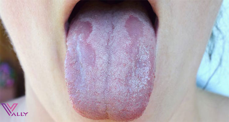 درمان قارچ زبان
