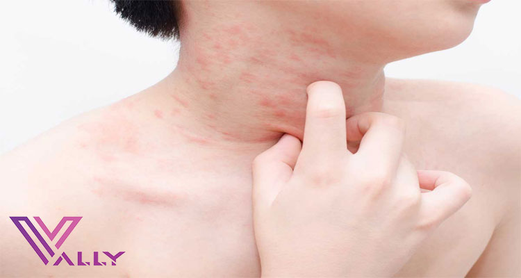 دلایل بروز حساسیت پوستی