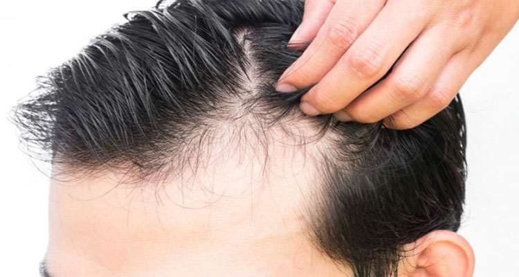 دلایل ریزش مو در مردان