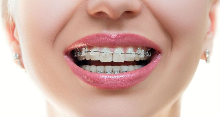 تکنیک کاهش درد فک و دندان بعد ارتودنسی
