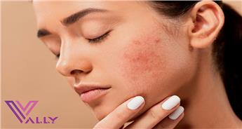 حساسیت پوستی (درماتیت) چیست؟ نشانه‌ ها و راه‌‌ های درمان آن